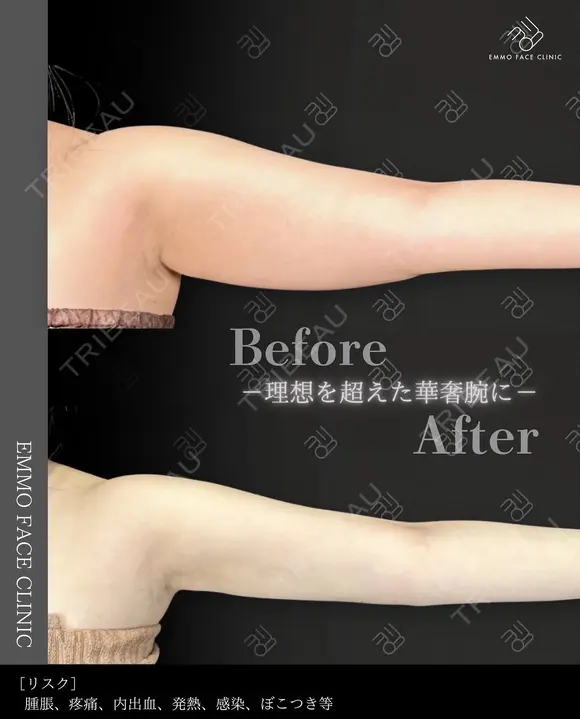 二の腕脂肪吸引（二の腕振袖・肩） before画像 メイン用