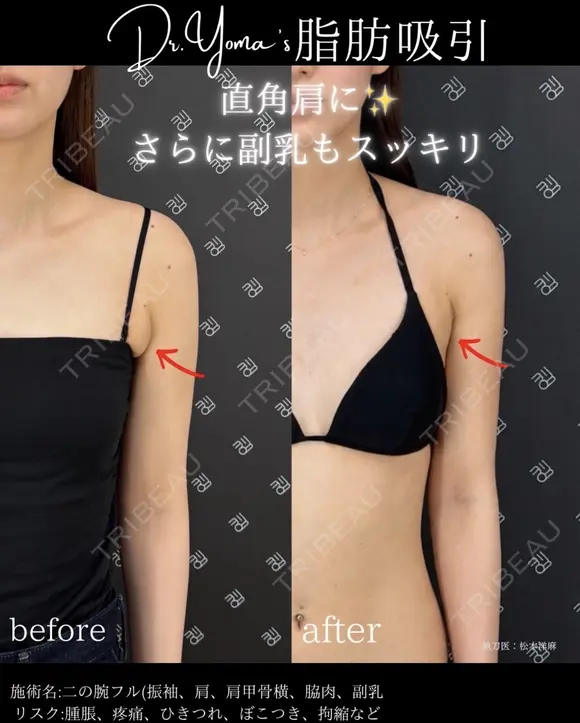 二の腕脂肪吸引（二の腕フル：二の腕振袖・肩・肩骨横・ブラファット） after画像 メイン用