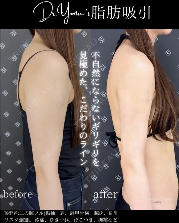 二の腕脂肪吸引（二の腕フル：二の腕振袖・肩・肩骨横・ブラファット） after画像 メイン用
