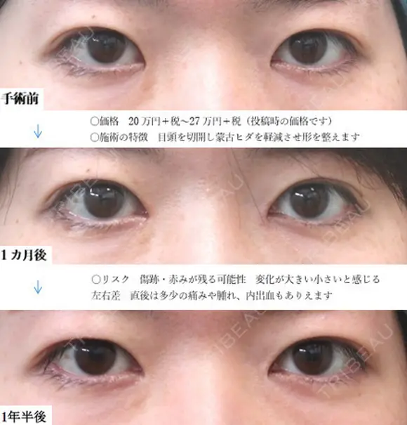 目頭切開法 before画像 メイン用
