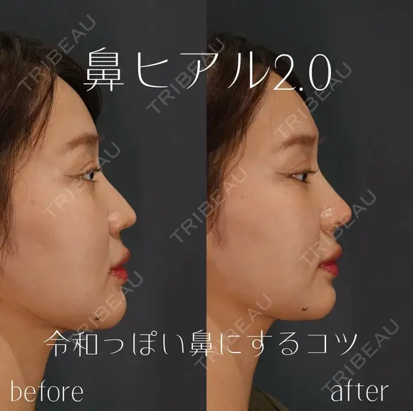 鼻ヒアルロン酸 before画像 メイン用