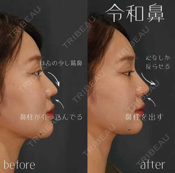 鼻ヒアルロン酸 after画像 メイン用