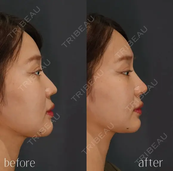 鼻ヒアルロン酸 after画像 メイン用