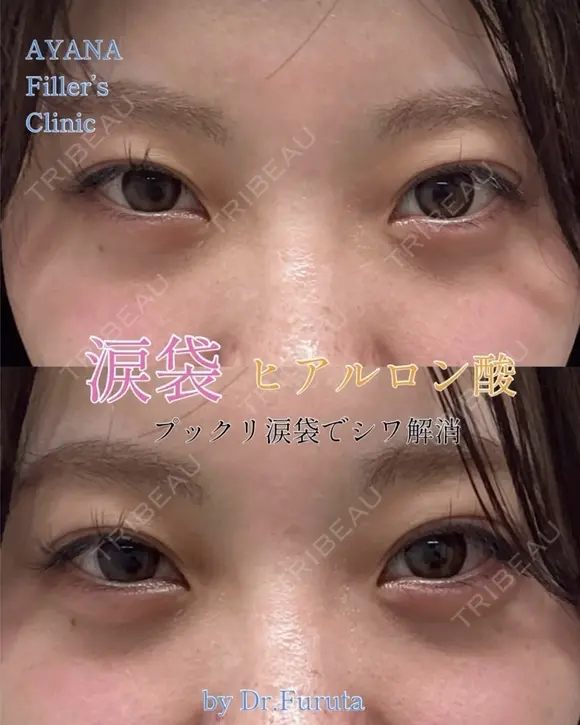 涙袋ヒアルロン酸 after画像 メイン用