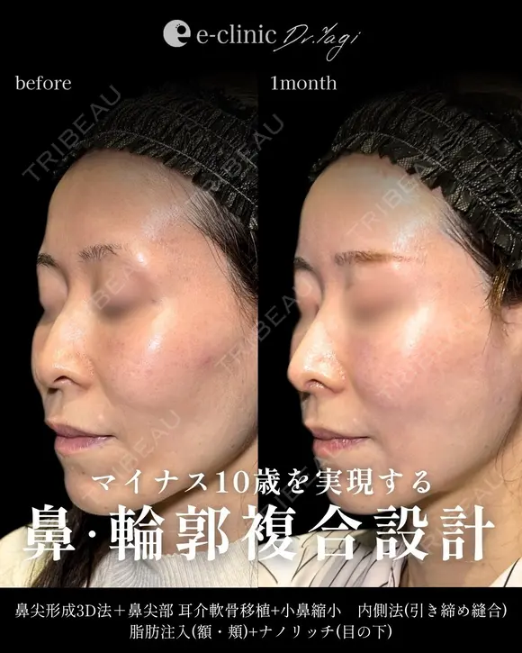鼻整形 after画像 メイン用