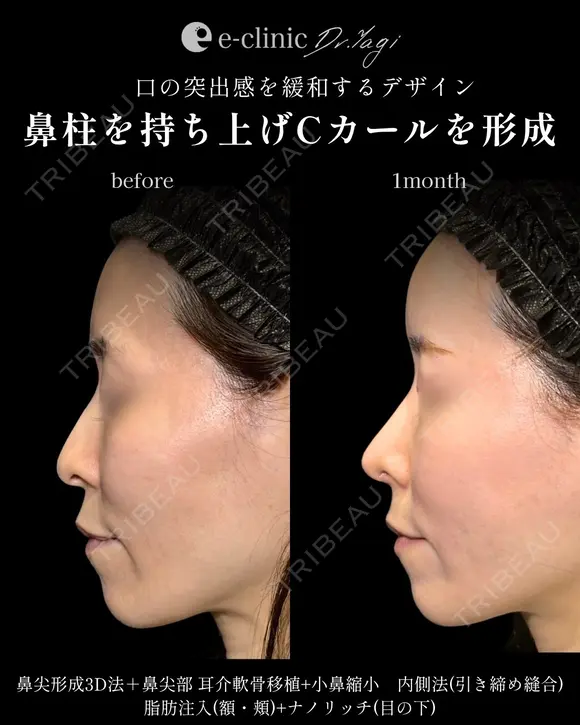 鼻整形 before画像 メイン用