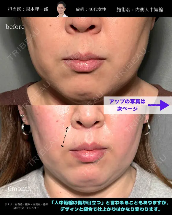 人中短縮 after画像 メイン用