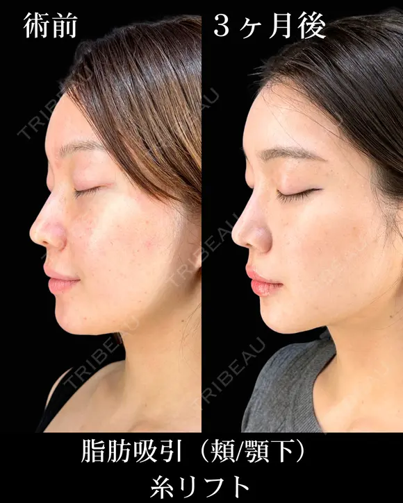 顔脂肪吸引/糸リフト before画像 メイン用
