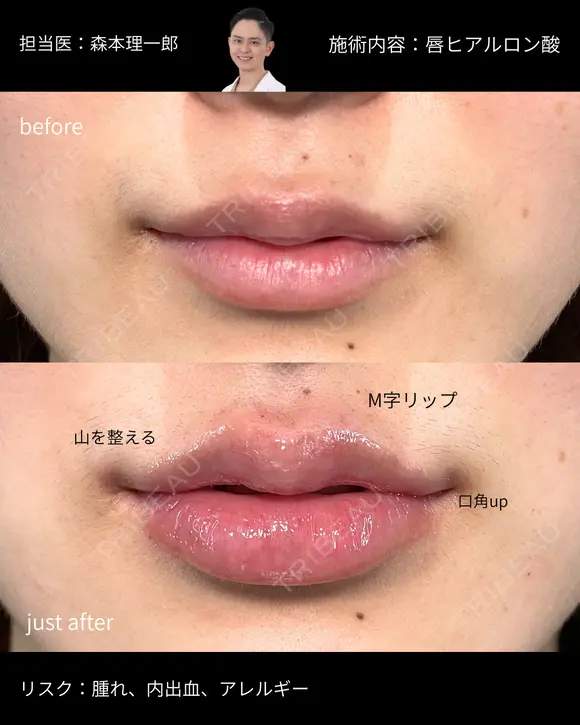 唇ヒアルロン酸 after画像 メイン用