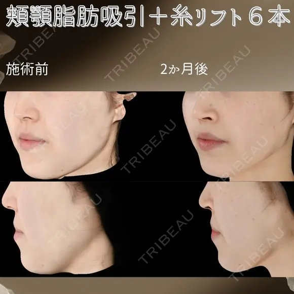 顔脂肪吸引＋糸リフト after画像 メイン用