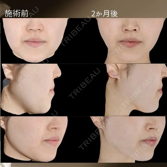 顔脂肪吸引＋糸リフト after画像 メイン用