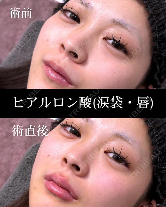 ヒアルロン酸(涙袋・唇) 0日後 メイン用