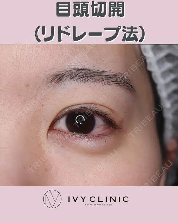 目頭切開(リドレープ法) before画像 メイン用