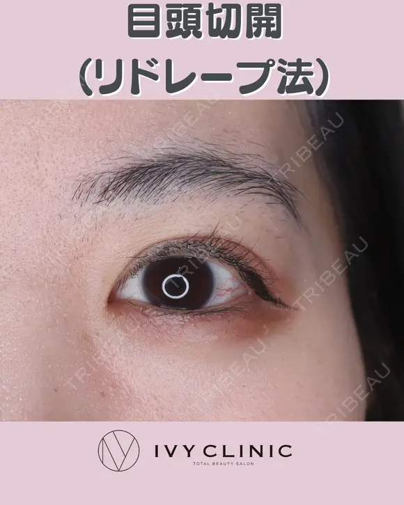 目頭切開(リドレープ法) after画像 メイン用