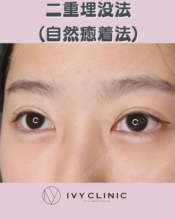 二重埋没(自然癒着) after画像 メイン用