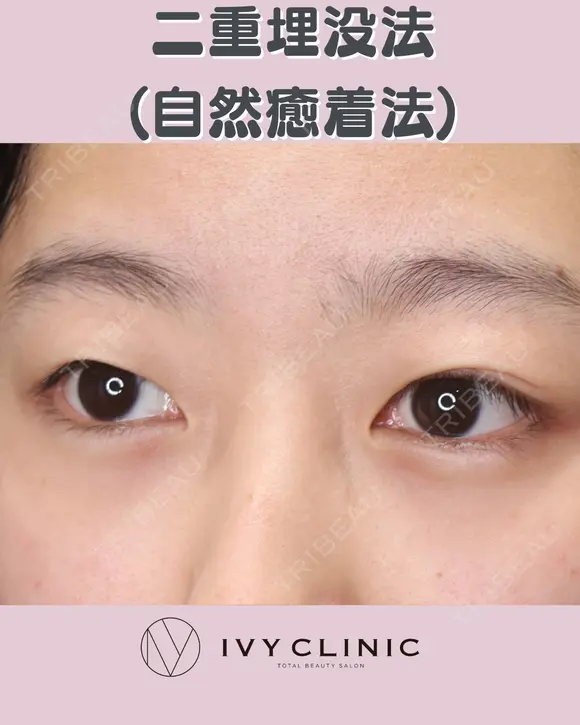 二重埋没(自然癒着) before画像 メイン用
