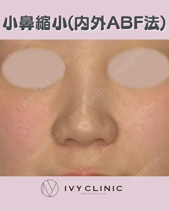 小鼻縮小(内外ABF法) before画像 メイン用