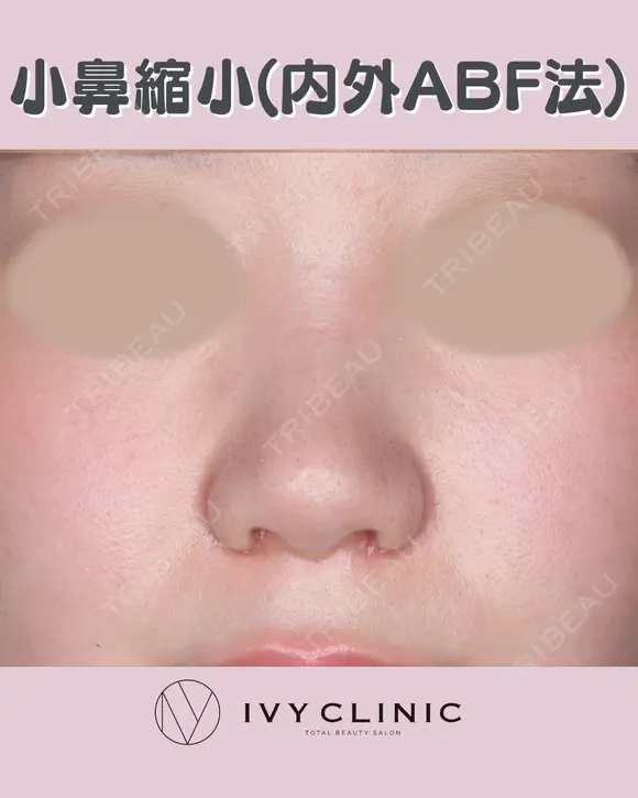 小鼻縮小(内外ABF法) after画像 メイン用