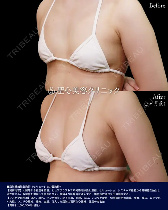 脂肪幹細胞豊胸術（セリューション豊胸術） before画像 メイン用