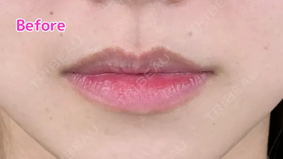 Cカールリップ　ボルベラ before画像 メイン用
