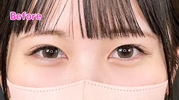 涙袋ヒアルロン酸　ボルベラ before画像 メイン用