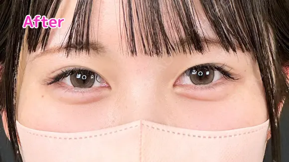 涙袋ヒアルロン酸　ボルベラ after画像 メイン用