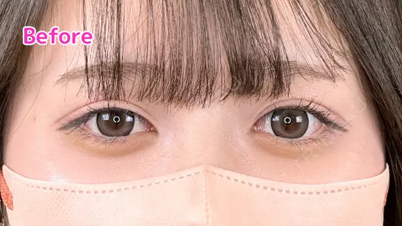 涙袋ヒアルロン酸　ボルベラ before画像 メイン用
