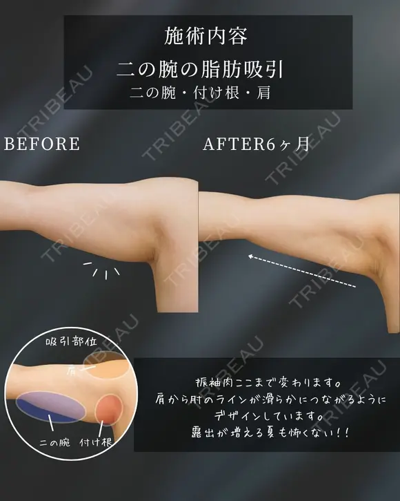 もう隠さない二の腕に🪄 before画像 メイン用