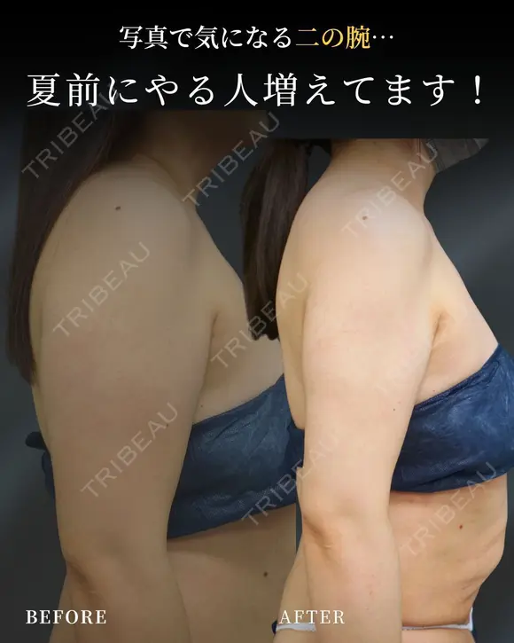 もう隠さない二の腕に🪄 after画像 メイン用