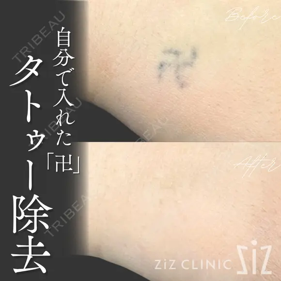 【タトゥー除去】自分で入れた卍 after画像 メイン用