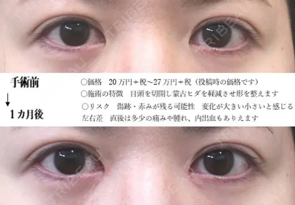 目頭切開法 30日後 メイン用