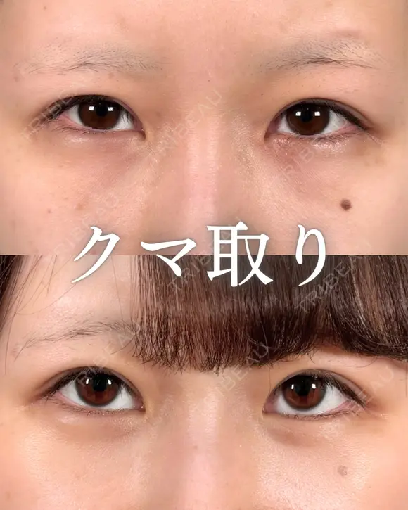クマ治療🌿 31日後 メイン用