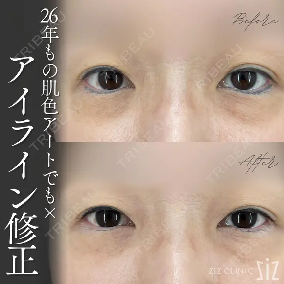 【アートメイク除去】26年もの肌色アートでも× after画像 メイン用