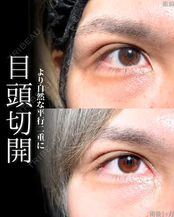 目頭切開 after画像 メイン用