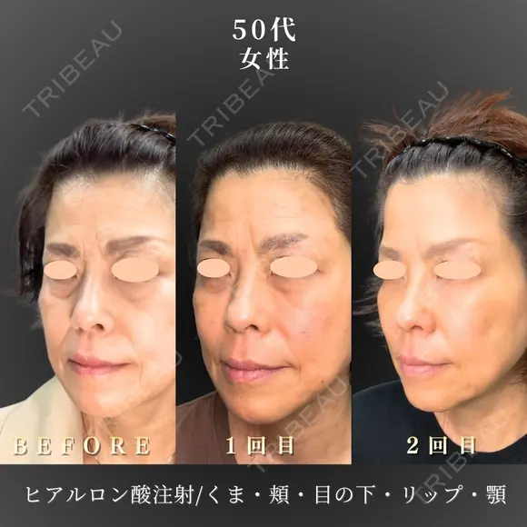フェイスリフト/ヒアルロン酸注入 before画像 メイン用