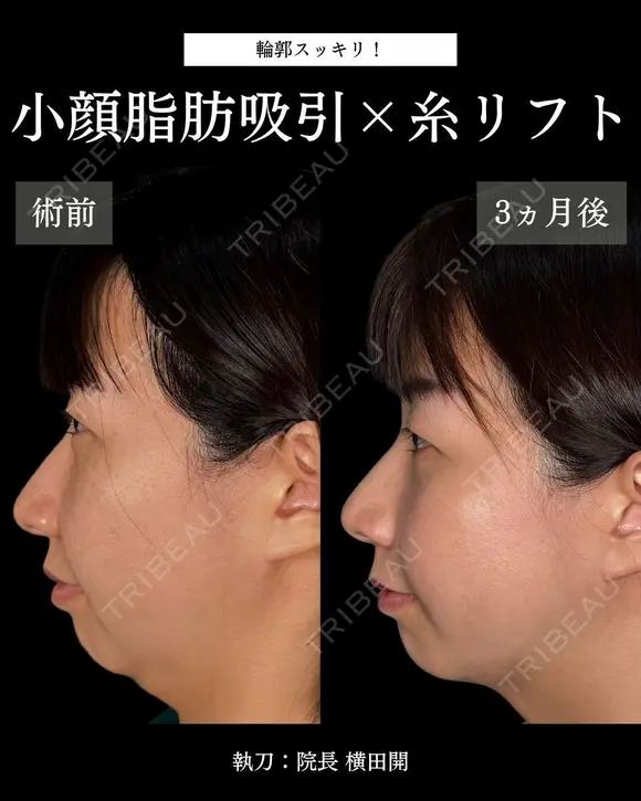 🦋フェイスライン爆誕🦋 before画像 メイン用
