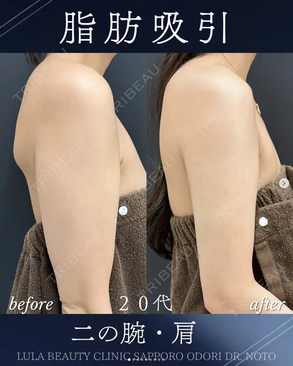 二の腕+肩　脂肪吸引 before画像 メイン用