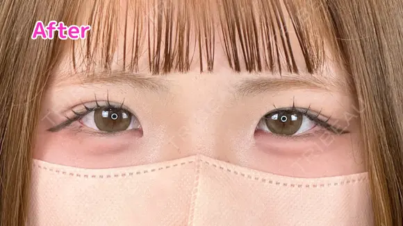 エターナル二重術 after画像 メイン用