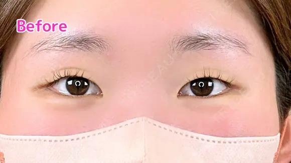 エターナル二重術 before画像 メイン用