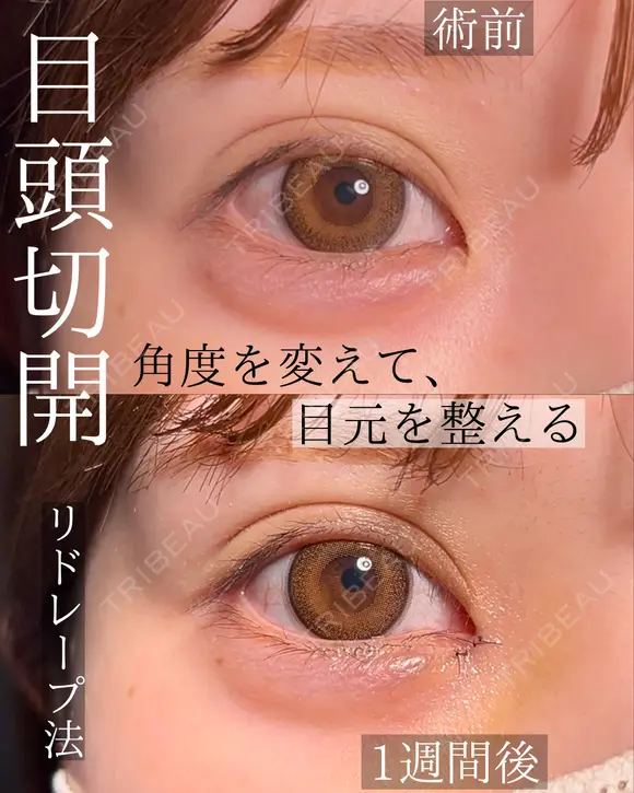 目頭切開 30日後 メイン用
