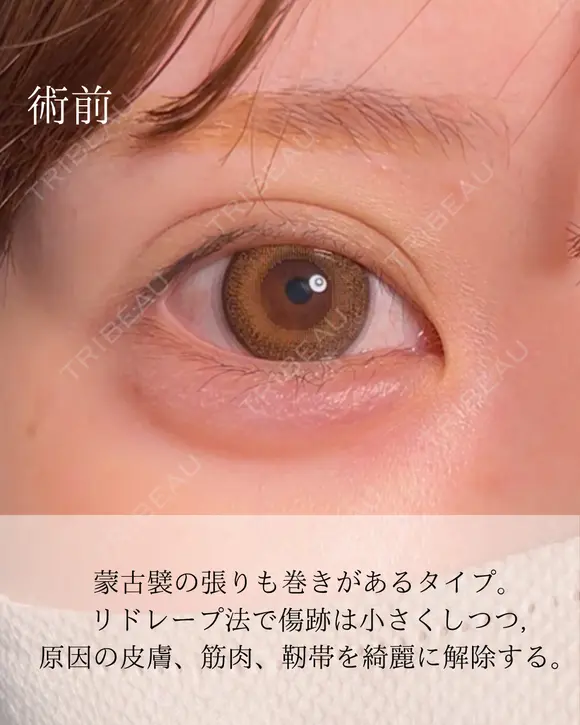 目頭切開 before画像 メイン用