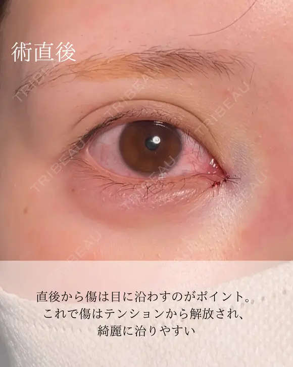 目頭切開 after画像 メイン用