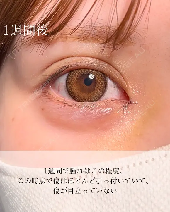 目頭切開 7日後 メイン用