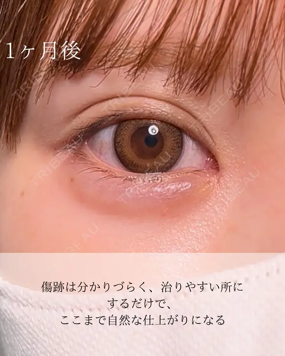 目頭切開 30日後 メイン用