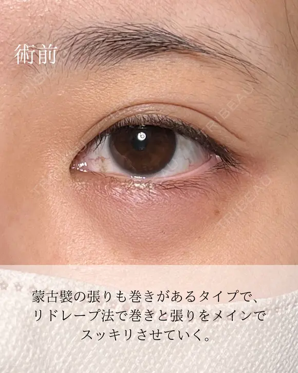 目頭切開リドレープ法 before画像 メイン用