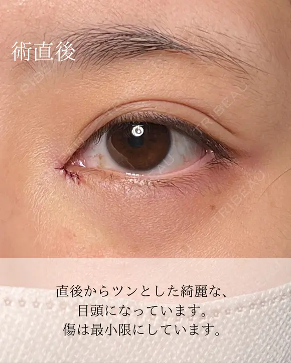 目頭切開リドレープ法 after画像 メイン用