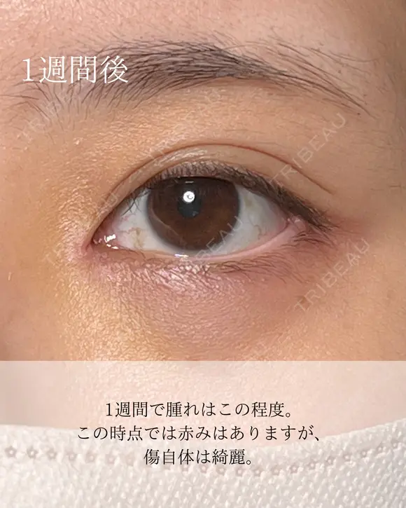 目頭切開リドレープ法 after画像 メイン用