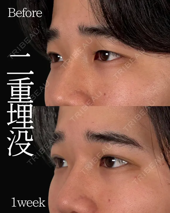 Dr岩切💙二重埋没💙 before画像 メイン用
