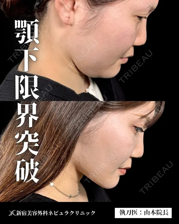 🎀顎下脂肪吸引🎀 90日後 メイン用