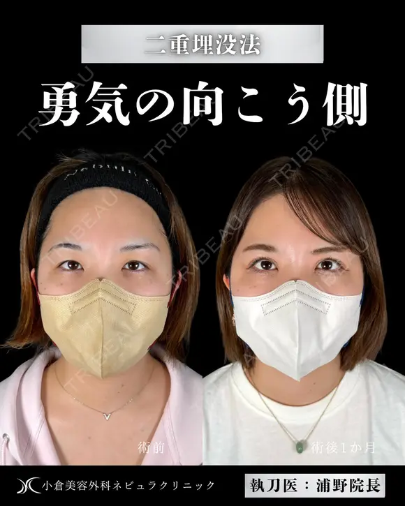 Dr浦野執刀🎀二重埋没法 before画像 メイン用